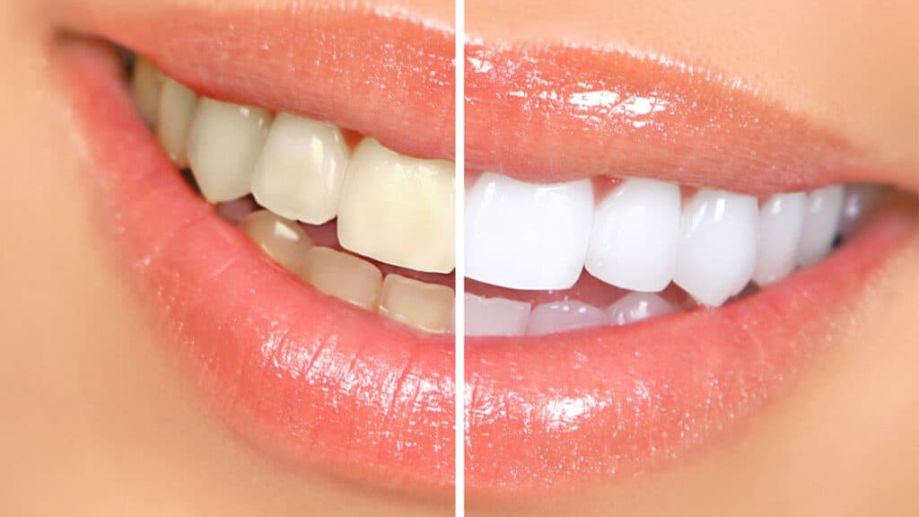 Before and after teeth whitening. Woman smiling showing teeth.