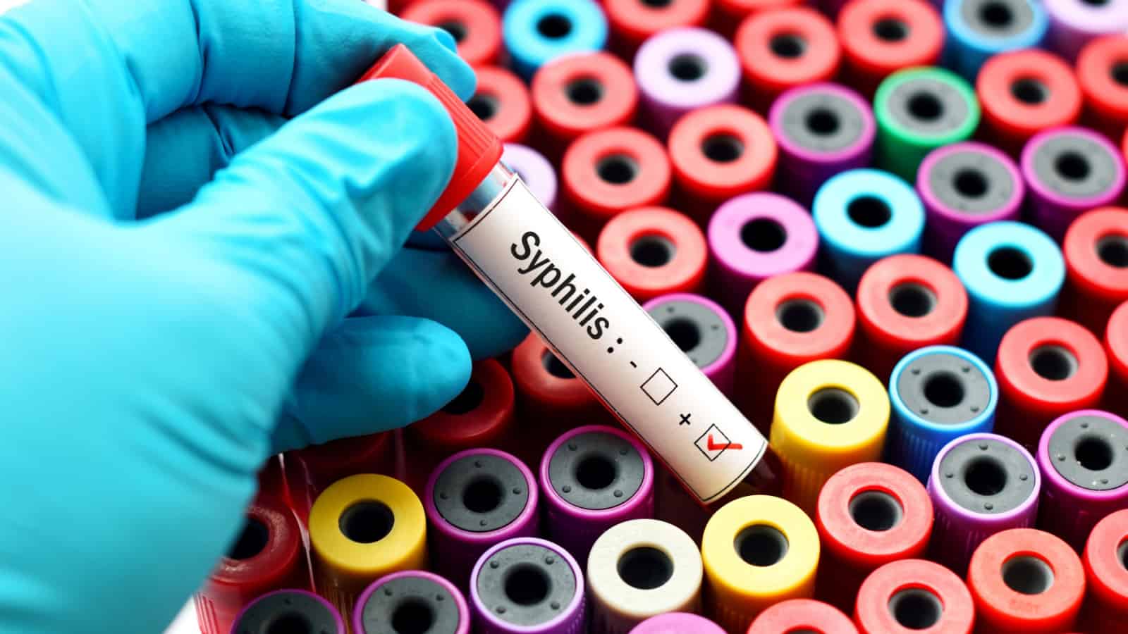 syphillis