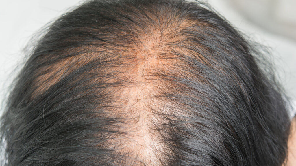 Top of woman's head with thinning hair. 