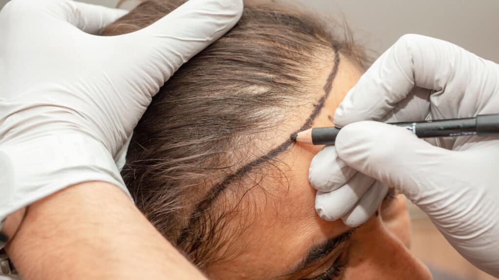 Woman being prepped for hair transplant. 