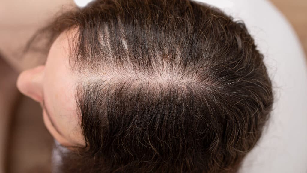 Woman with thinning hair part. 