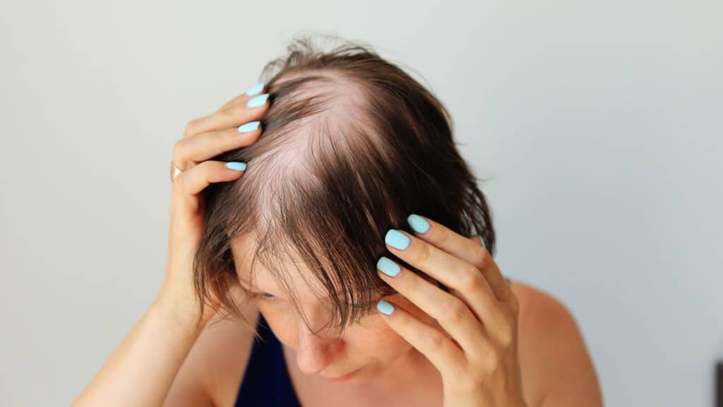 Woman with thinning hair.