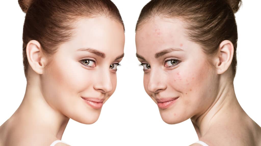 before and after acne. 