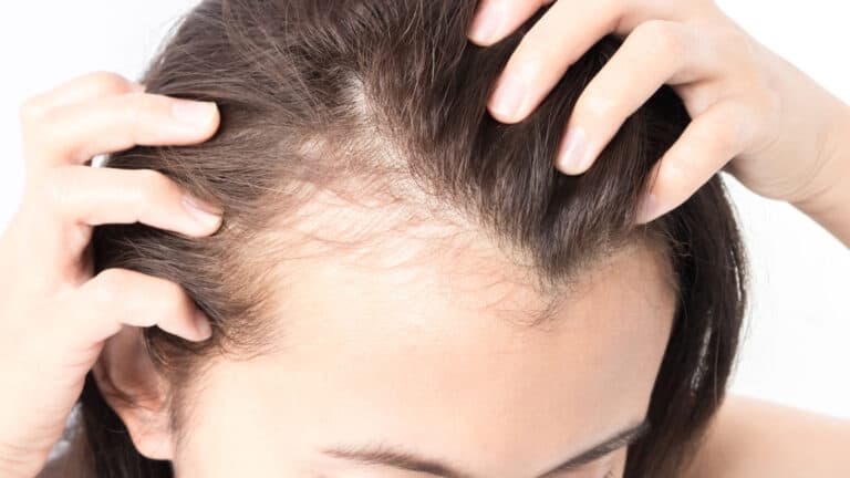 woman with thinning hair.