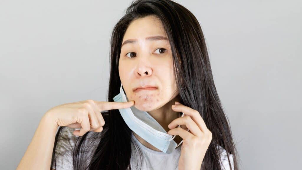woman with acne.