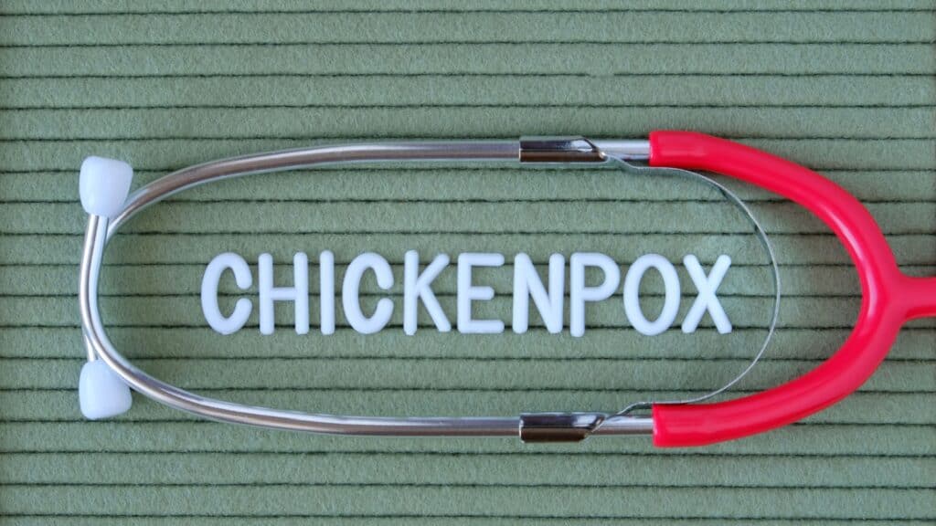 chicken pox. 