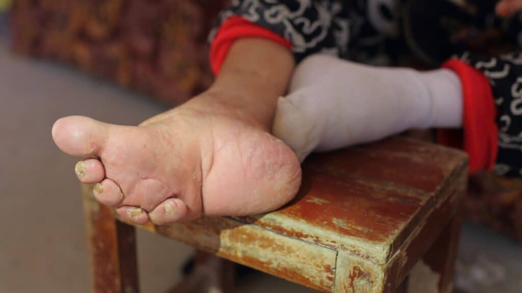 Footbinding.