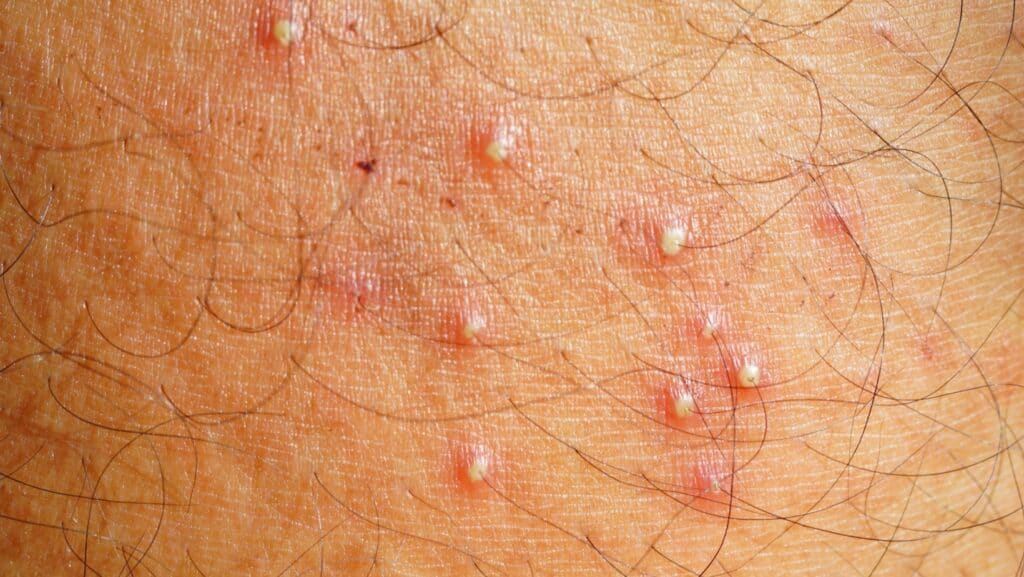 Folliculitis.