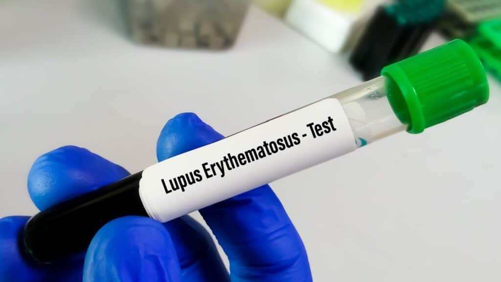 Lupus test.