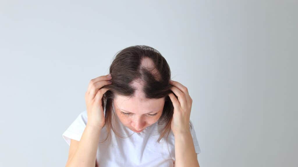 alopecia areata. 