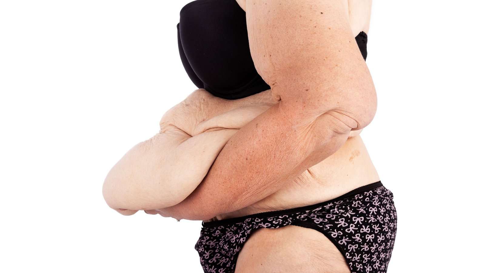 excess skin weight loss.