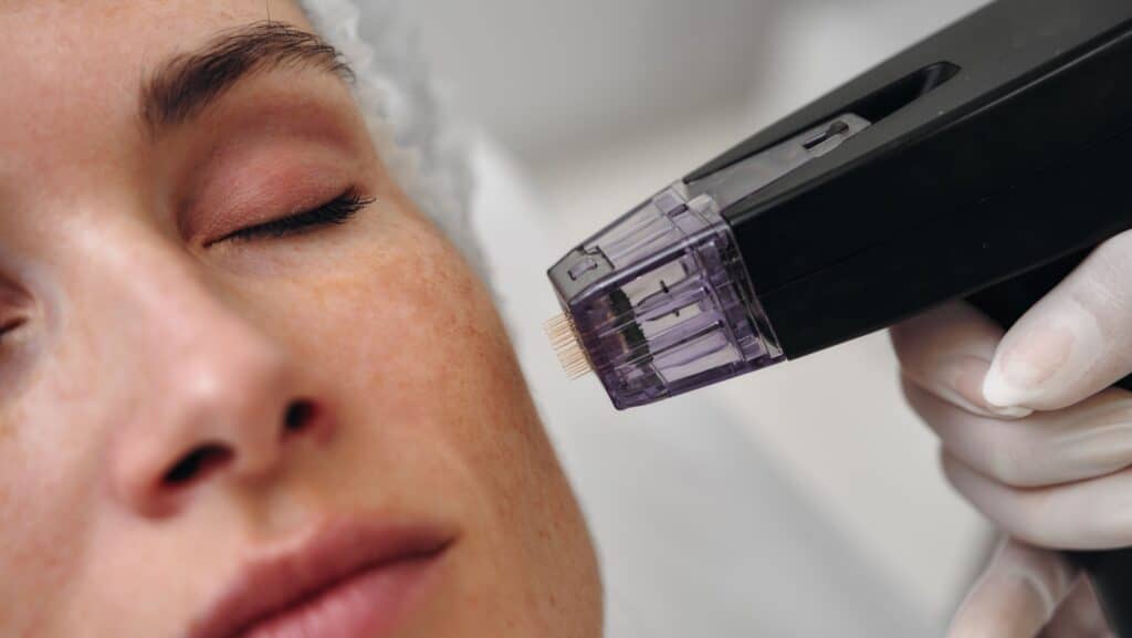 Microneedling. Rovsky via Shutterstock.