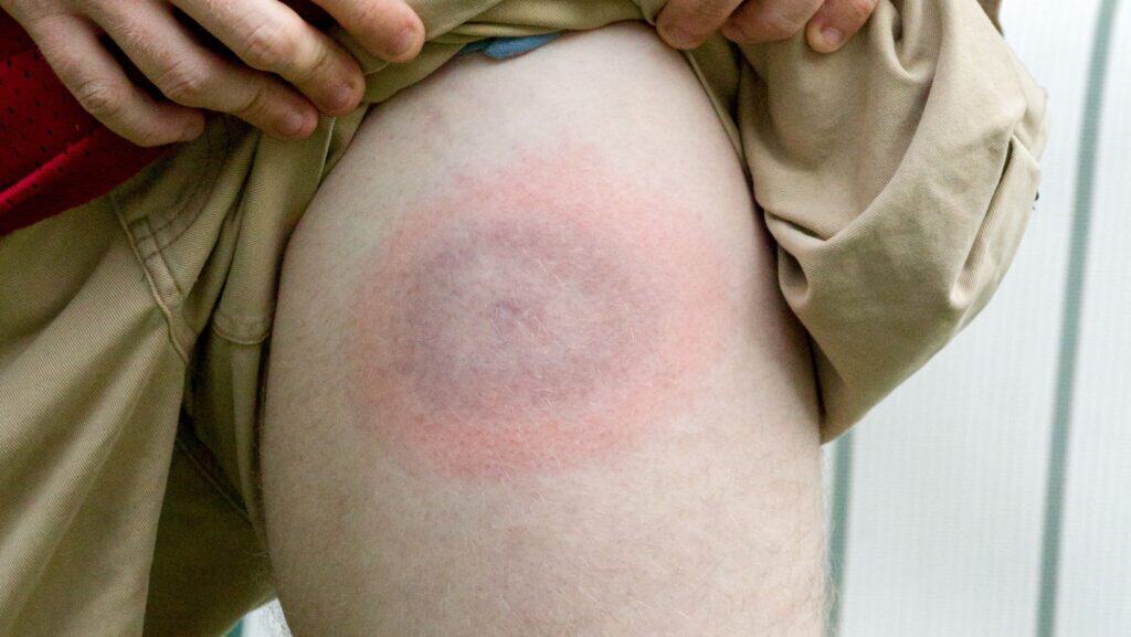 Tick Lyme bullseye.