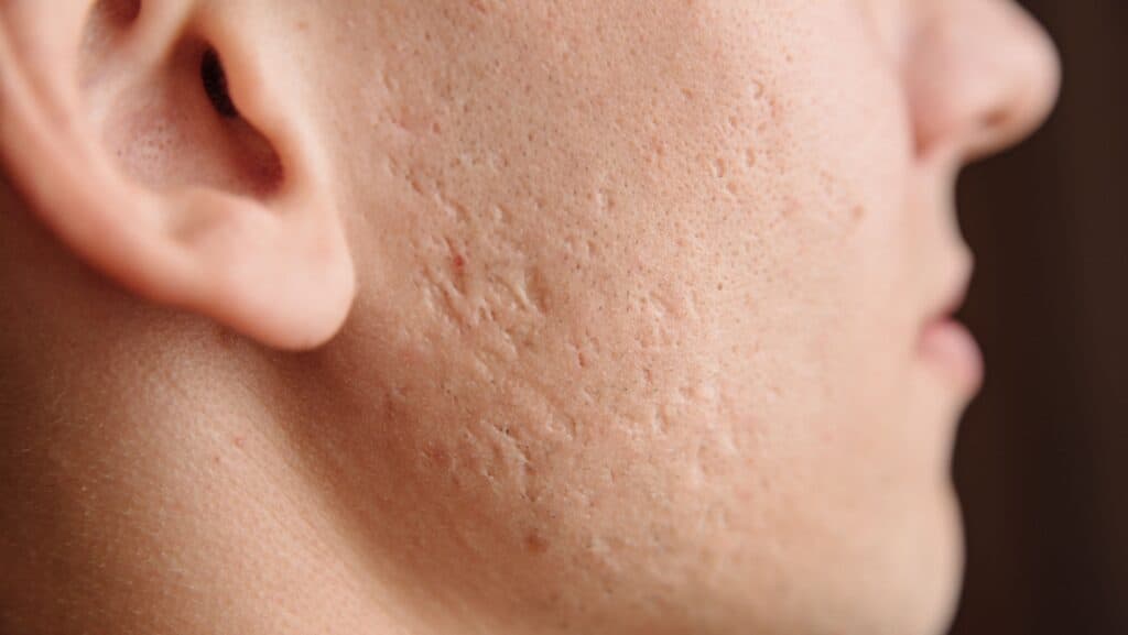 acne scars.