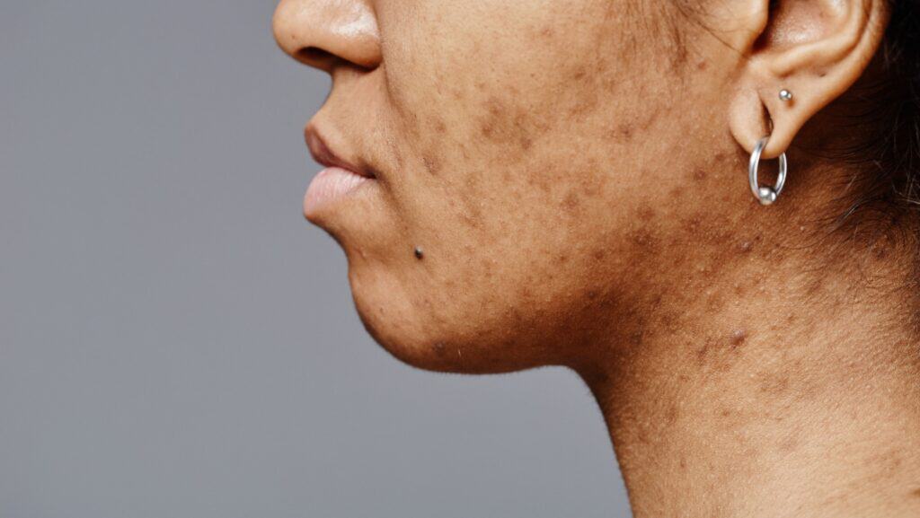 acne.