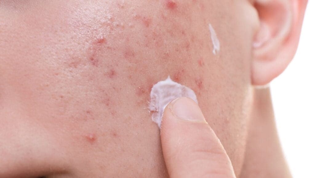 pimple cream.