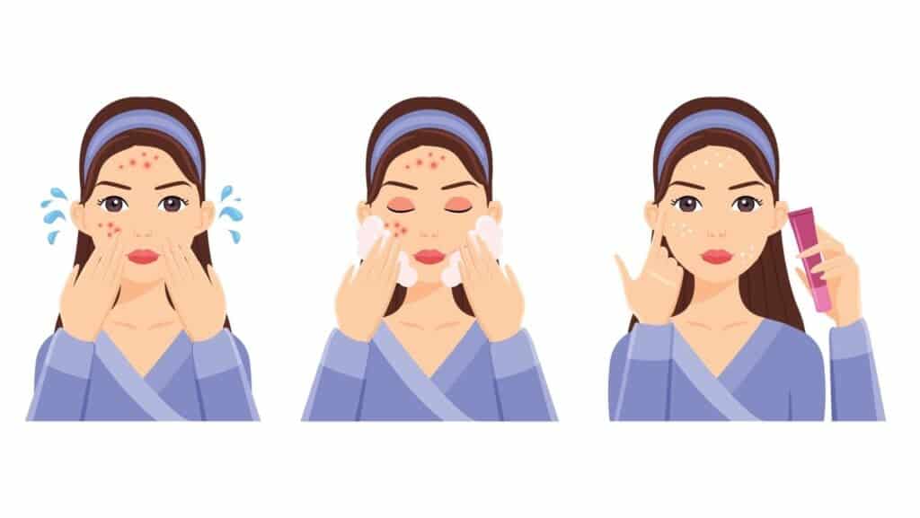 pimple cream.