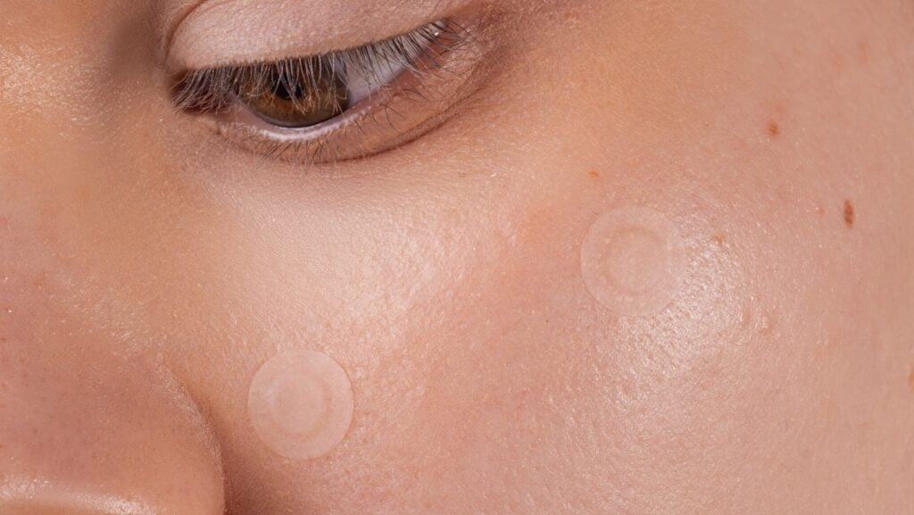 pimple patch.