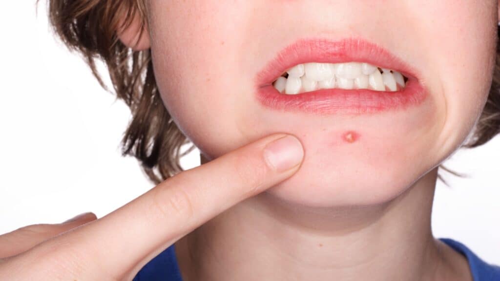 red pimple.