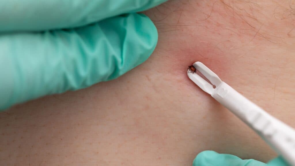 tick removal.
