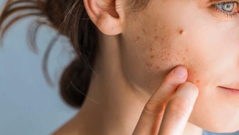 woman with acne.