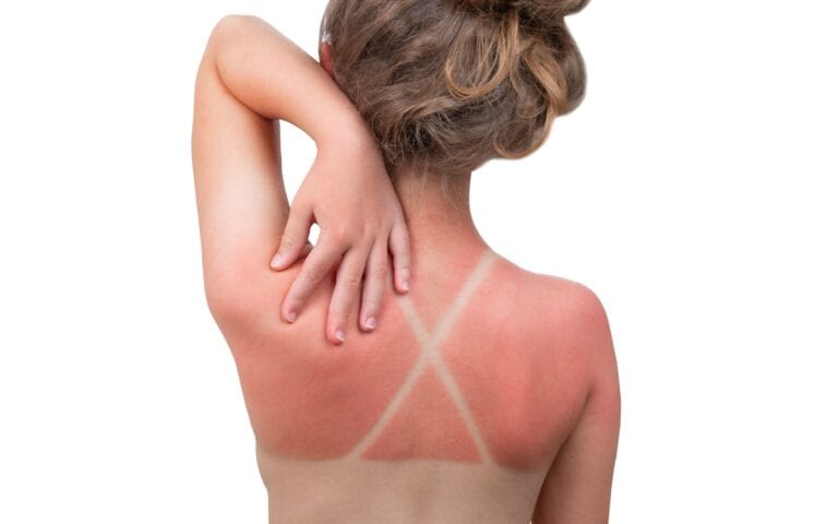 Sunburn. Girl got a Sunburn. Red painful skin on back that feels hot to the touch after beach visits. Use Sunscreen or UV protection cream. Summer vacation on ocean beach. White Isolated background.