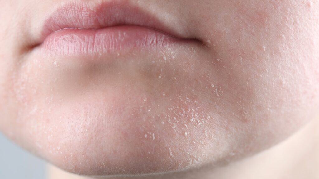 Dry skin on face.