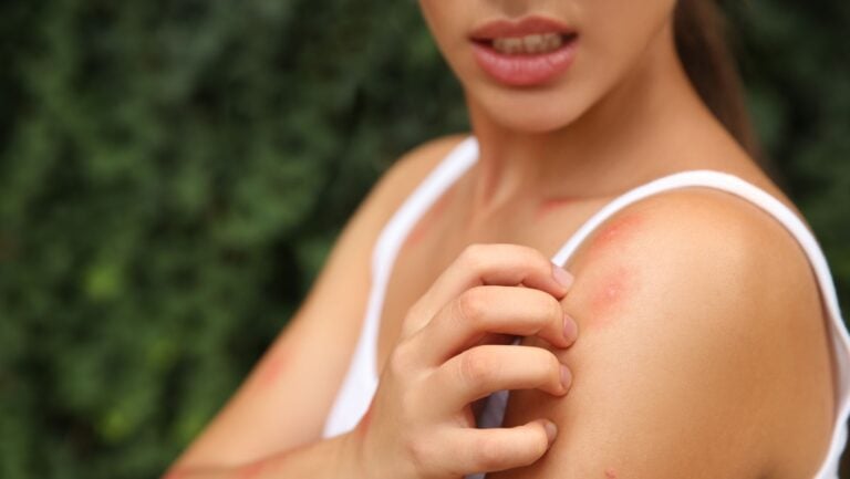 bug bites.