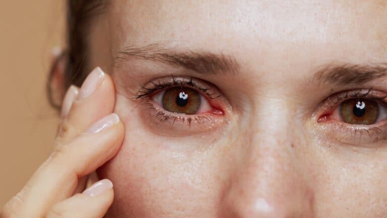 irritated eyes.