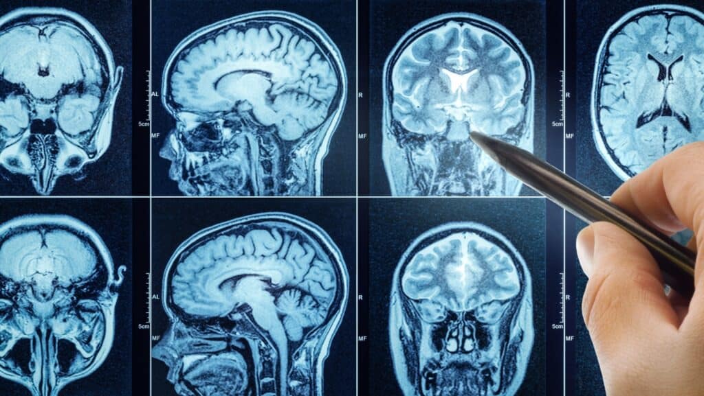 CT brain scan.