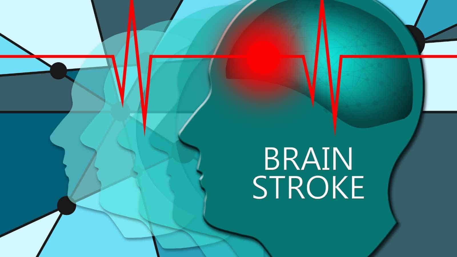Warning signs of a stroke that can appear a month in advance