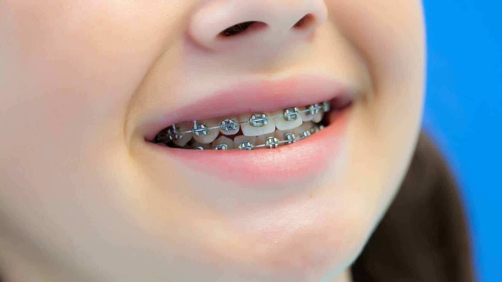 Braces