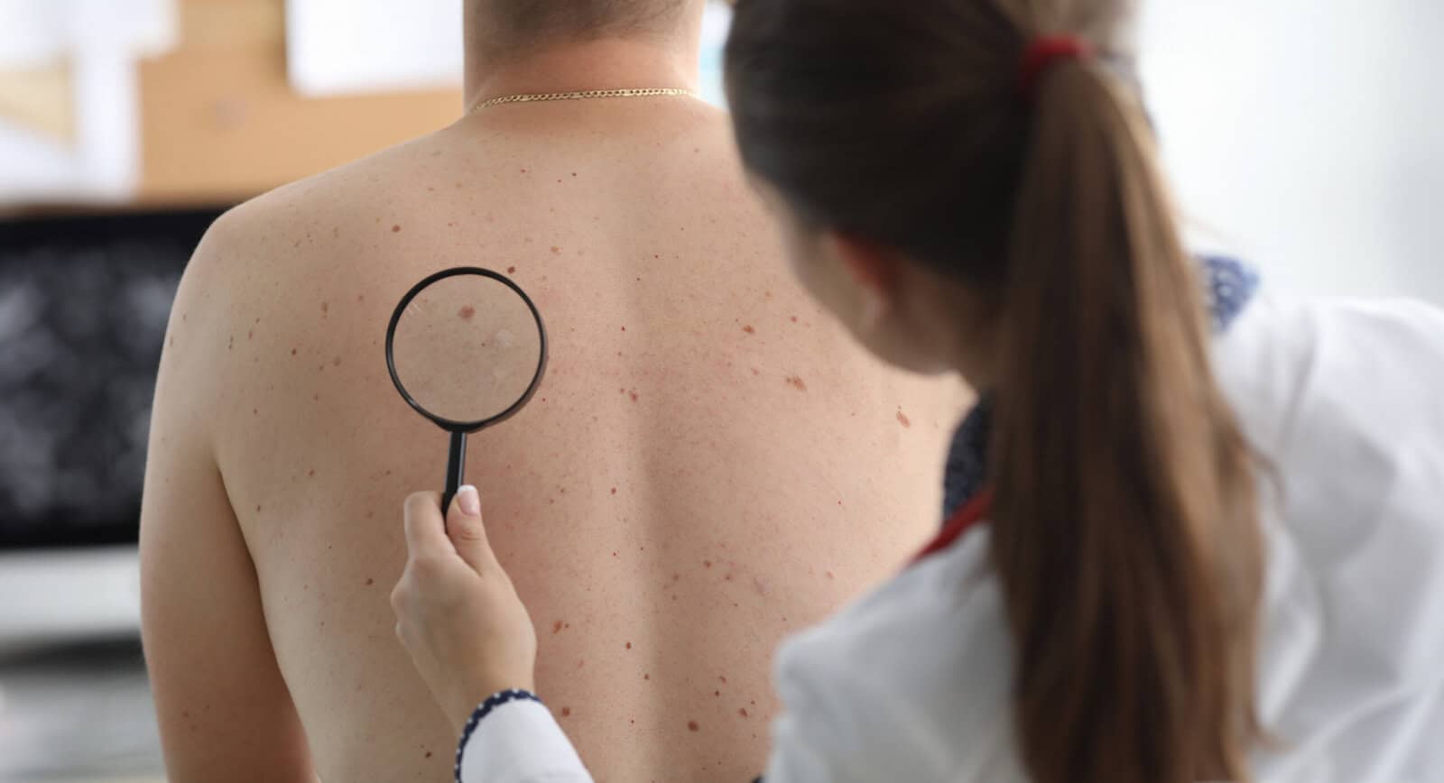 Oncologist holds magnifying glass in hand and examines pigmented nevi on patient's back in clinic