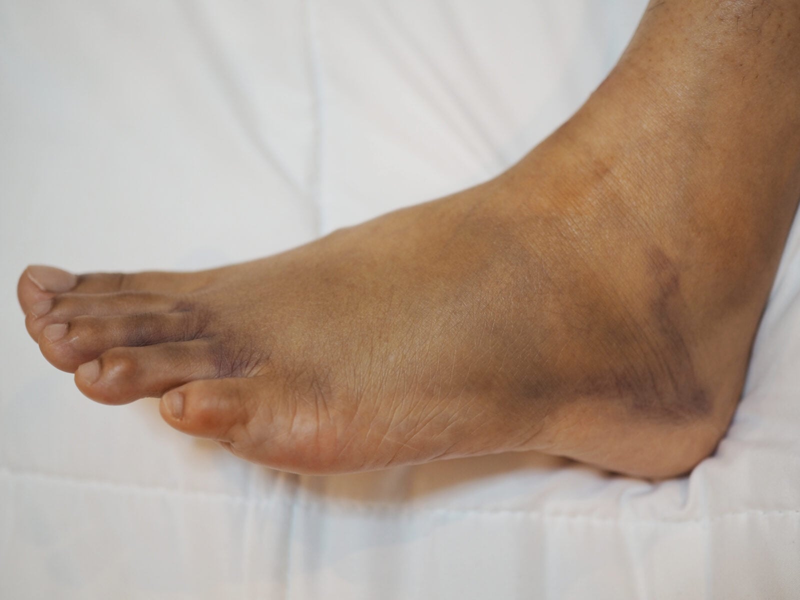 Swelling shows up
