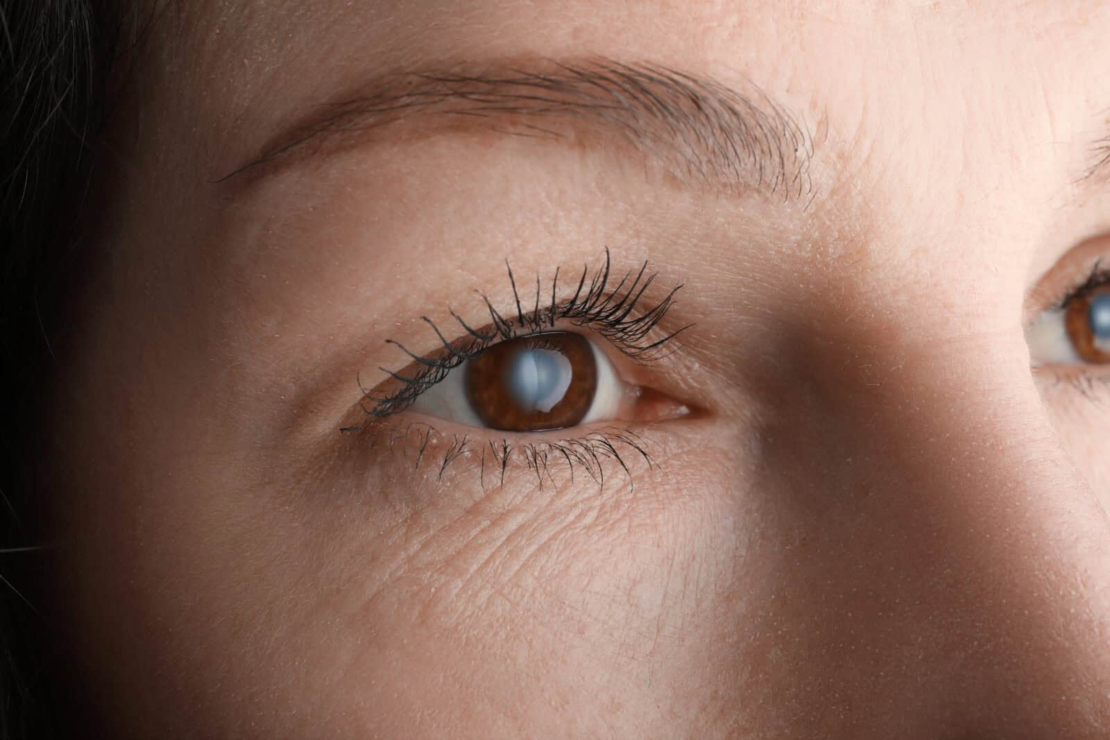 Woman suffering from a cataract