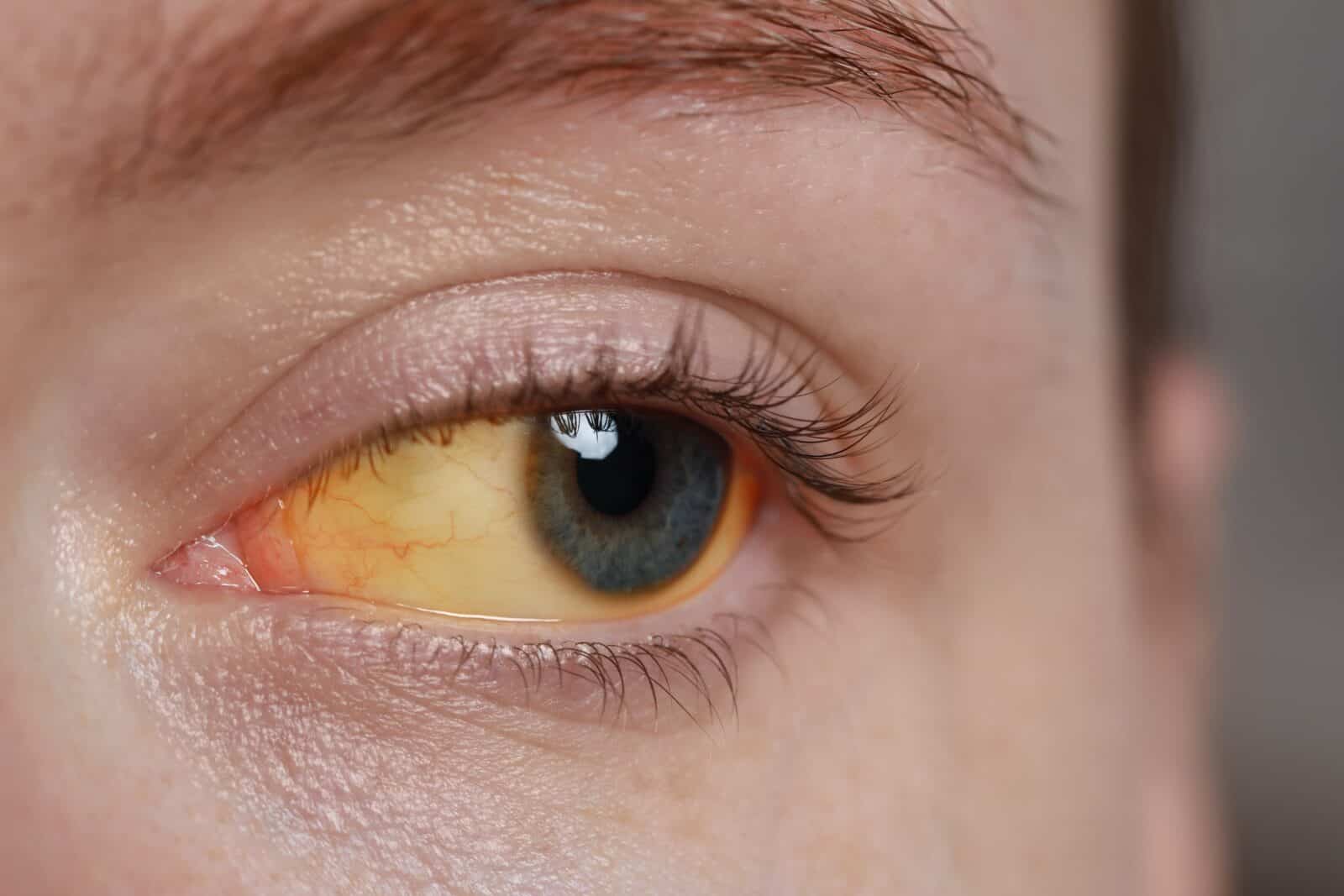 yellow eyes