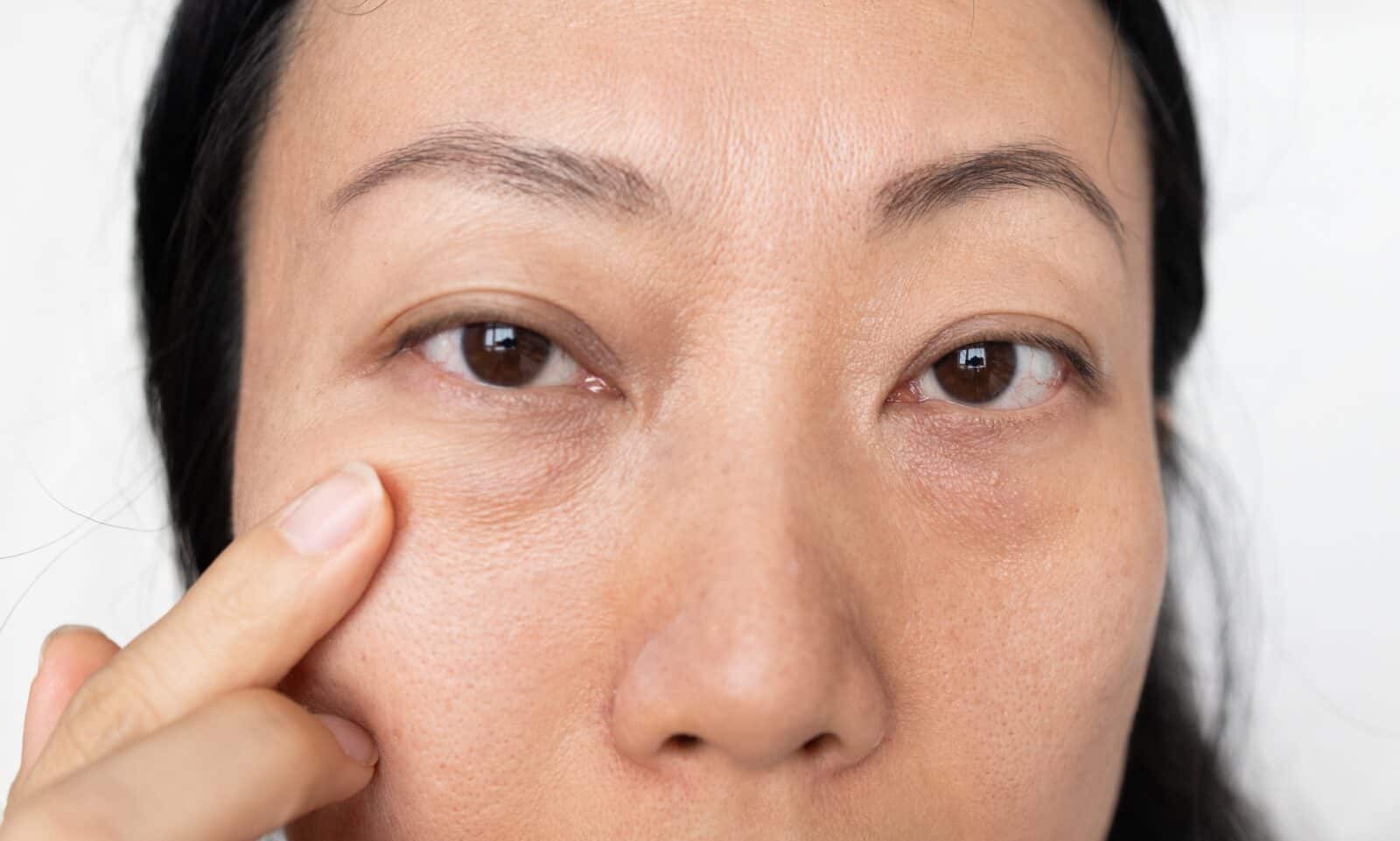 Puffy eyes