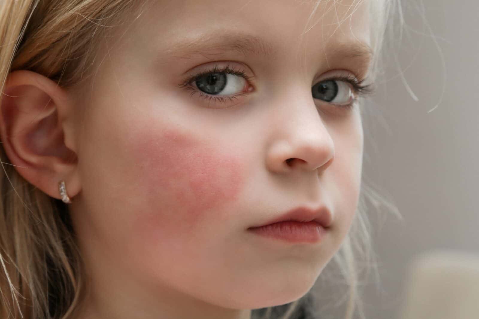 Butterfly rash