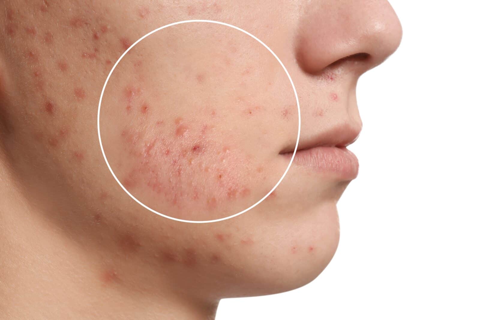 Rashes keep returning