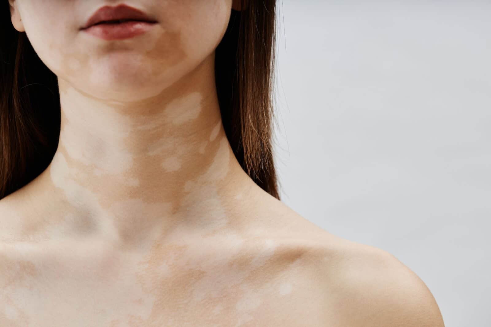 Skin discoloration