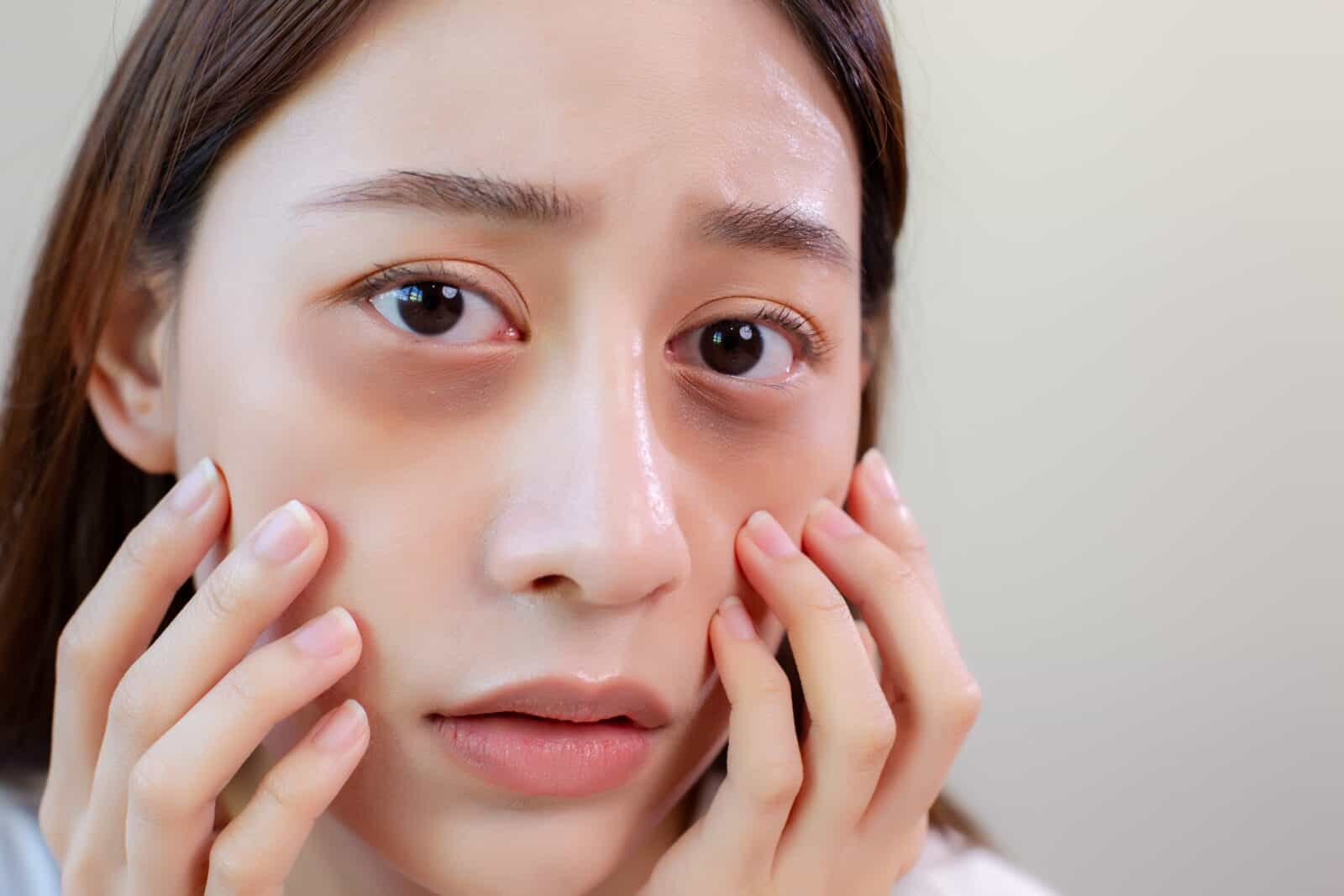 Dark circles